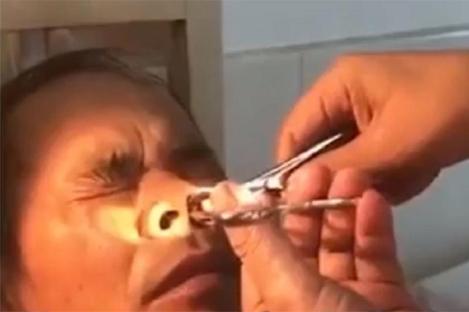 রোগীর নাকের মধ্যে জোঁক, অজ্ঞান নার্স!