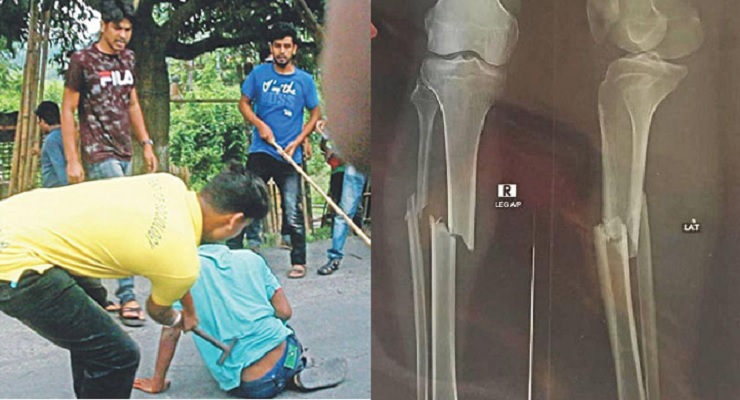 হাতুড়িপেটায় আহত তরিকুলকে ঢাকায় আনা হচ্ছে