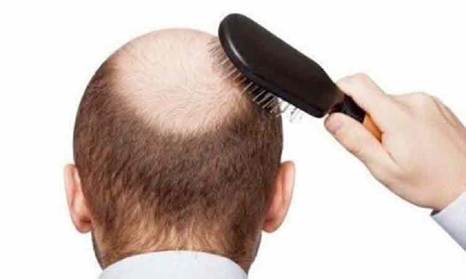 টাক পড়া রোধ করবে যেসব খাবার