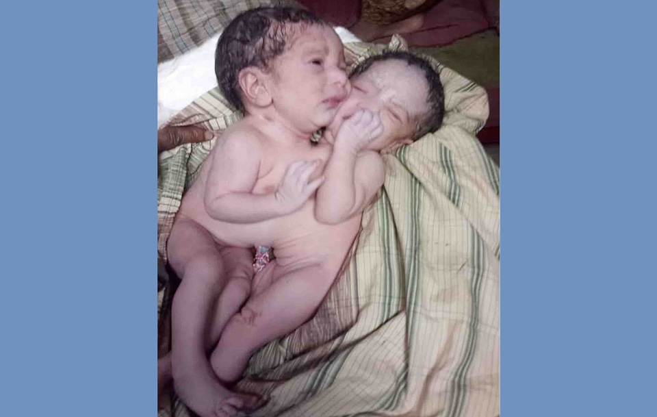 মান্দায় জোড়া লাগানো যমজ কন্যা শিশুর জন্ম