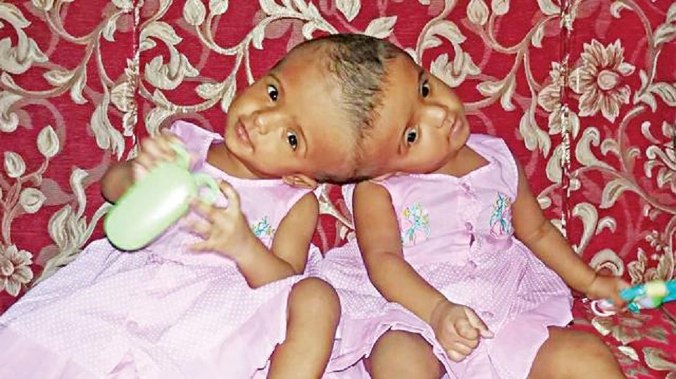 হাঙ্গেরী নেয়া হচ্ছে জমজ শিশু রাবেয়া ও রোকেয়াকে