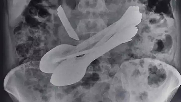 রোগীর পেট থেকে বের করা হলো ছুরি চামচ স্ক্রু ডাইভার!