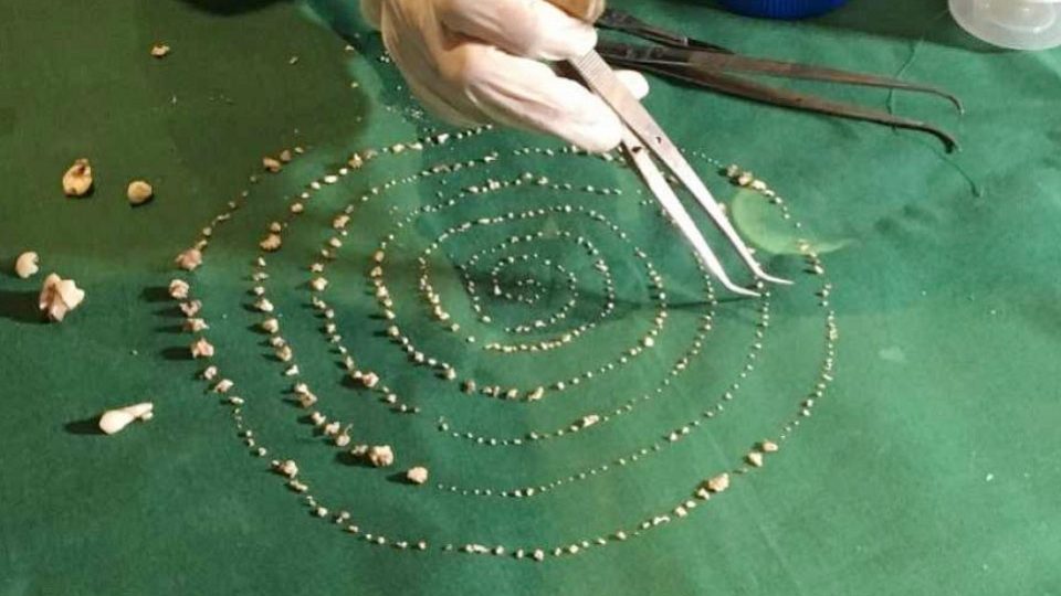 ৭ বছরের শিশুর মুখে ৫২৬টি দাঁত!