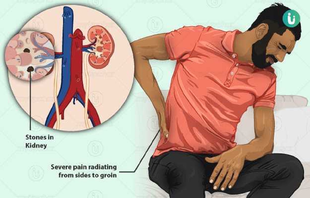 যেসব লক্ষণে বুঝবেন কিডনিতে পাথর, কী করবেন?