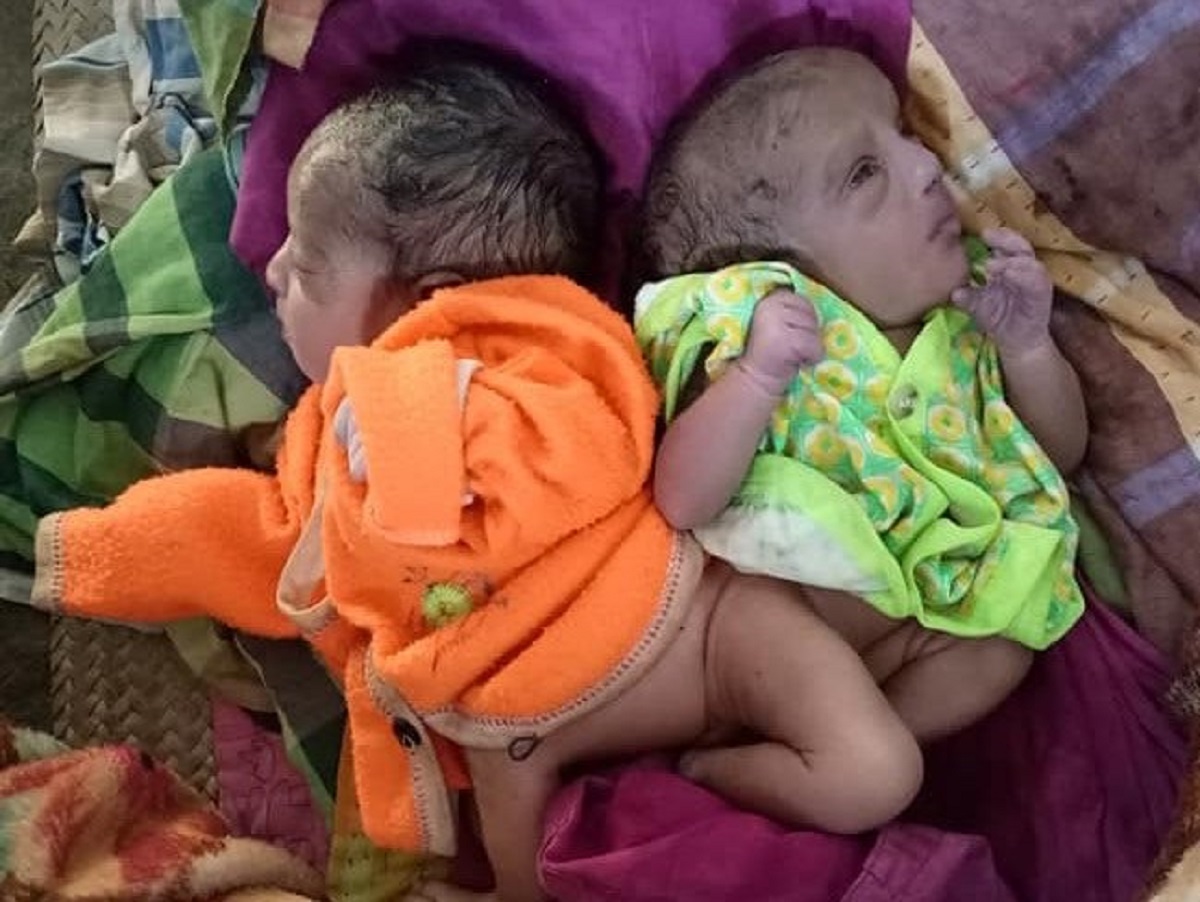 বড়াইগ্রামে জোড়া লাগা শিশুর জন্ম