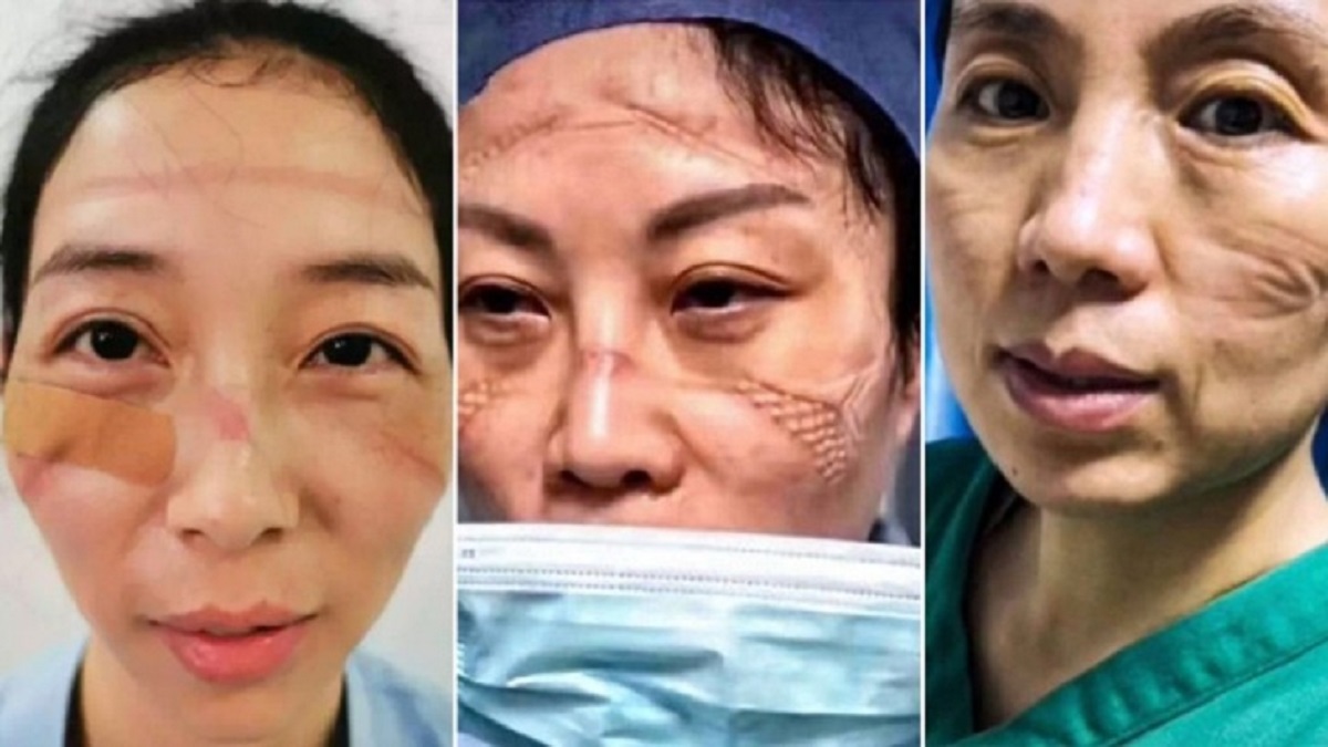 করোনাভাইরাস: মুখের ‘আকৃতি’ বদলে যাচ্ছে নার্সদের!