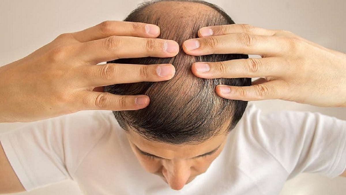 করোনা আক্রান্ত হওয়ার অধিক ঝুঁকিতে টাক মাথার মানুষেরা: গবেষণা