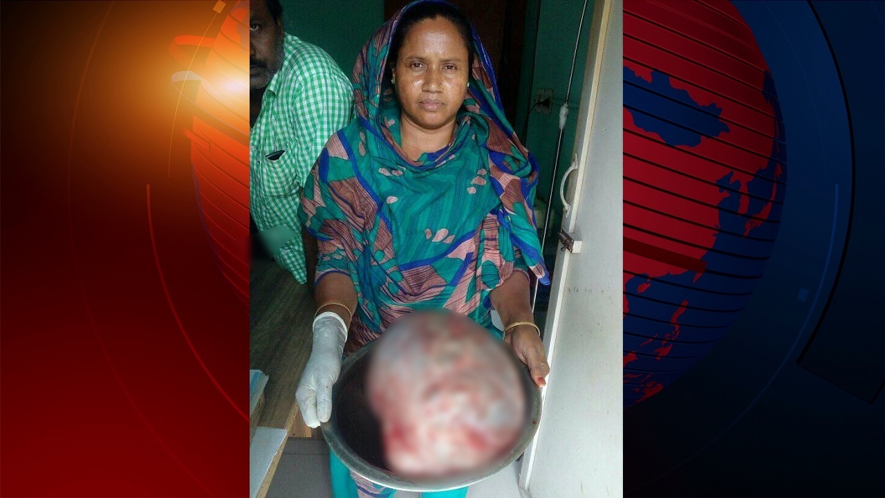 পাবনায় সাড়ে ৮ কেজি ওজনের টিউমারের অস্ত্রোপচার সম্পন্ন