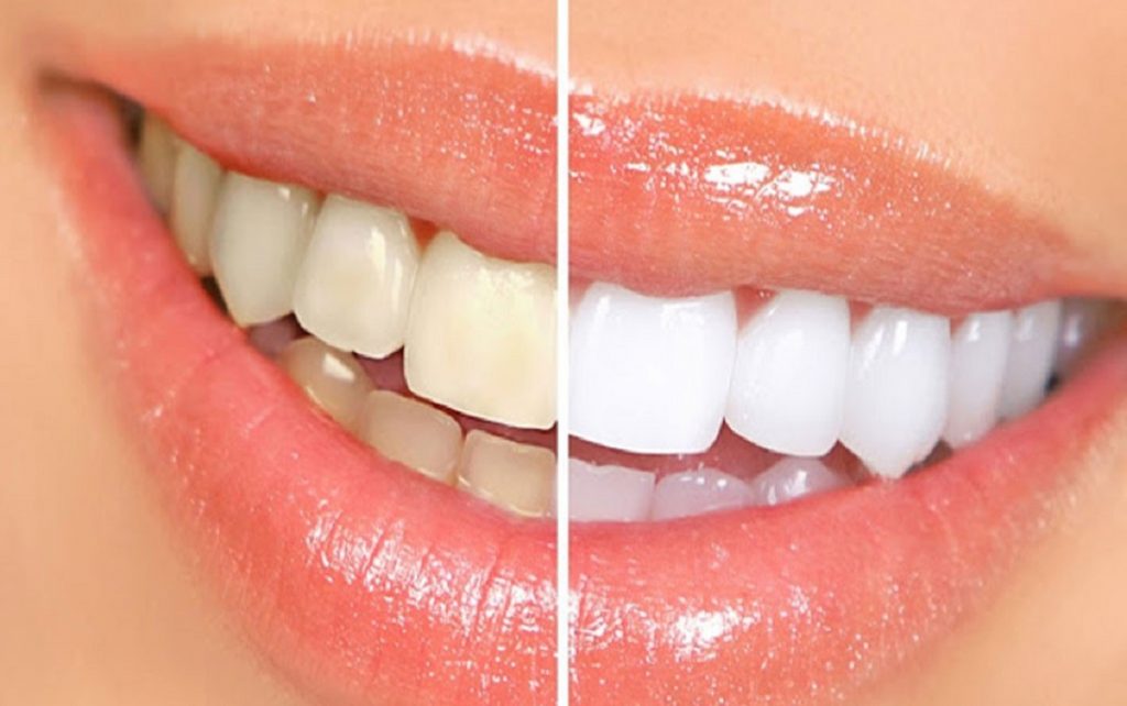 দাঁতের হলদে ভাব দূর করার উপায়