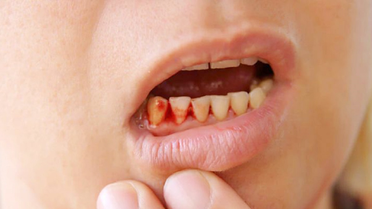 মাড়ি থেকে রক্তপাত: কারণ ও প্রতিকার