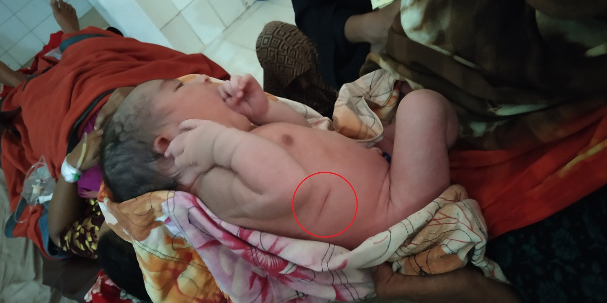 সিজার করতে গিয়ে নবজাতকের পেট কেটে ফেলল চিকিৎসক