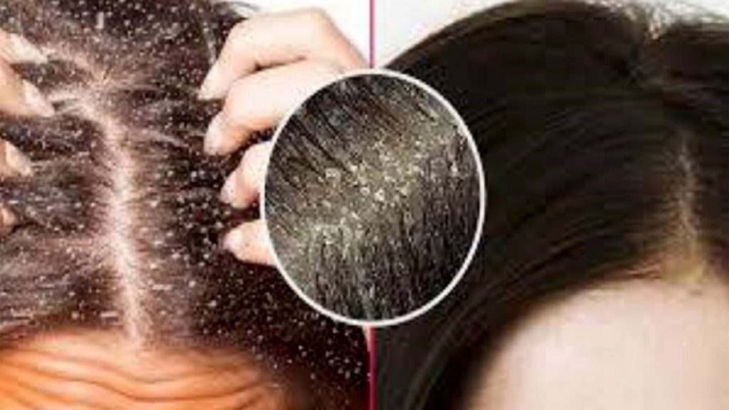 শীতে খুশকি দূর করতে করণীয়