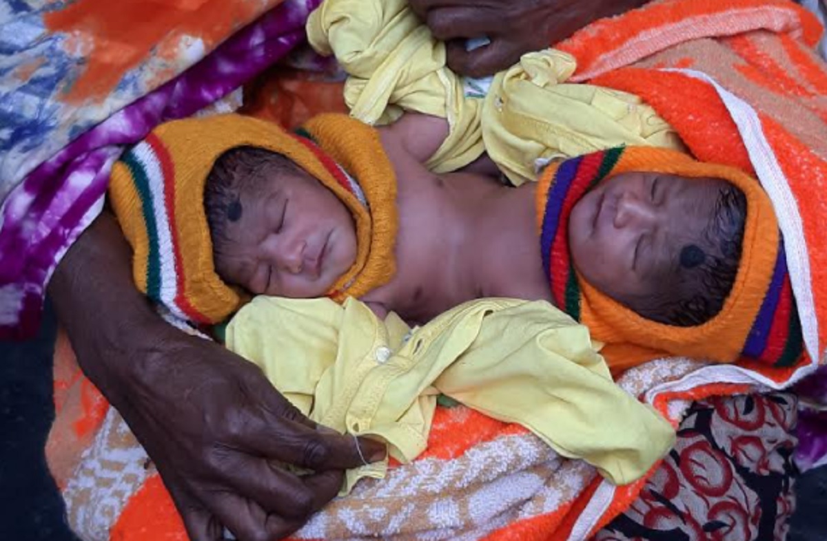 পেটের নিচ থেকে জোড়া লাগানো জমজ শিশু, চিকিৎসা নিয়ে দুশ্চিন্তায় মাতা-পিতা