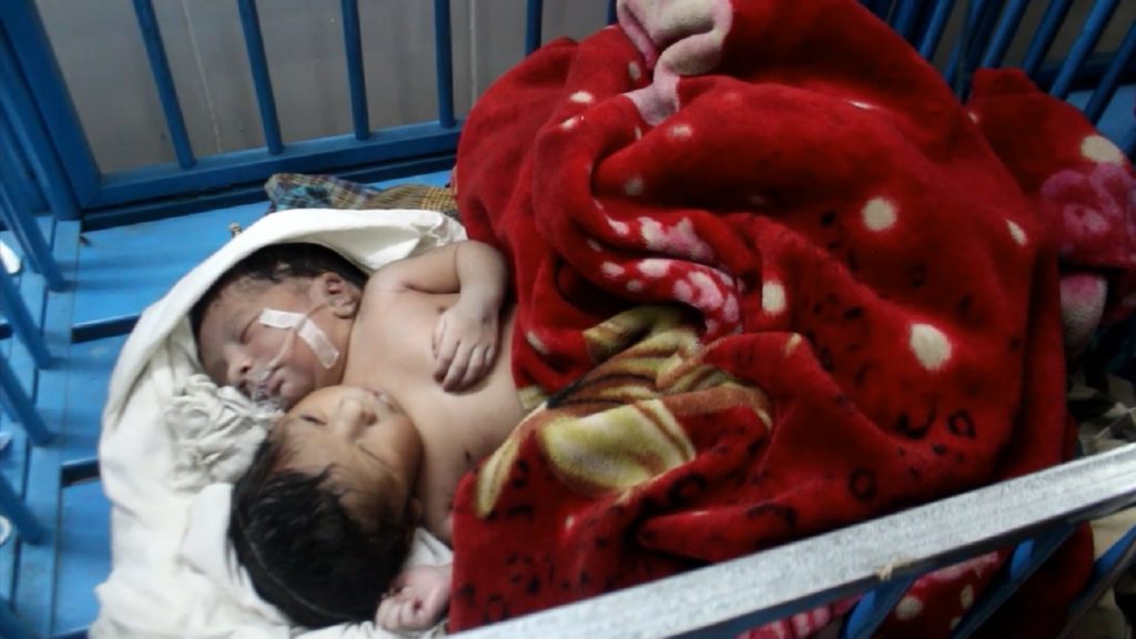 মাগুরায় দুই মাথা নিয়ে শিশুর জন্ম