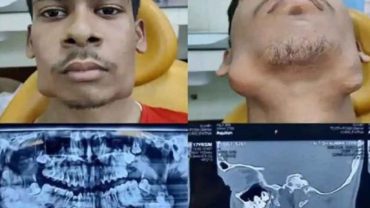 ১৭ বছরের তরুণের মুখে ১১৪টি দাঁত