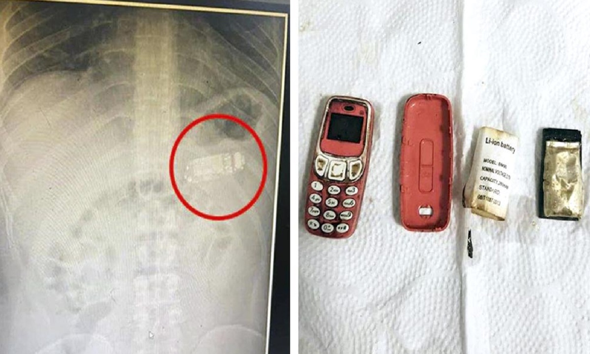 যুবকের পেটে আস্ত মোবাইল সেট