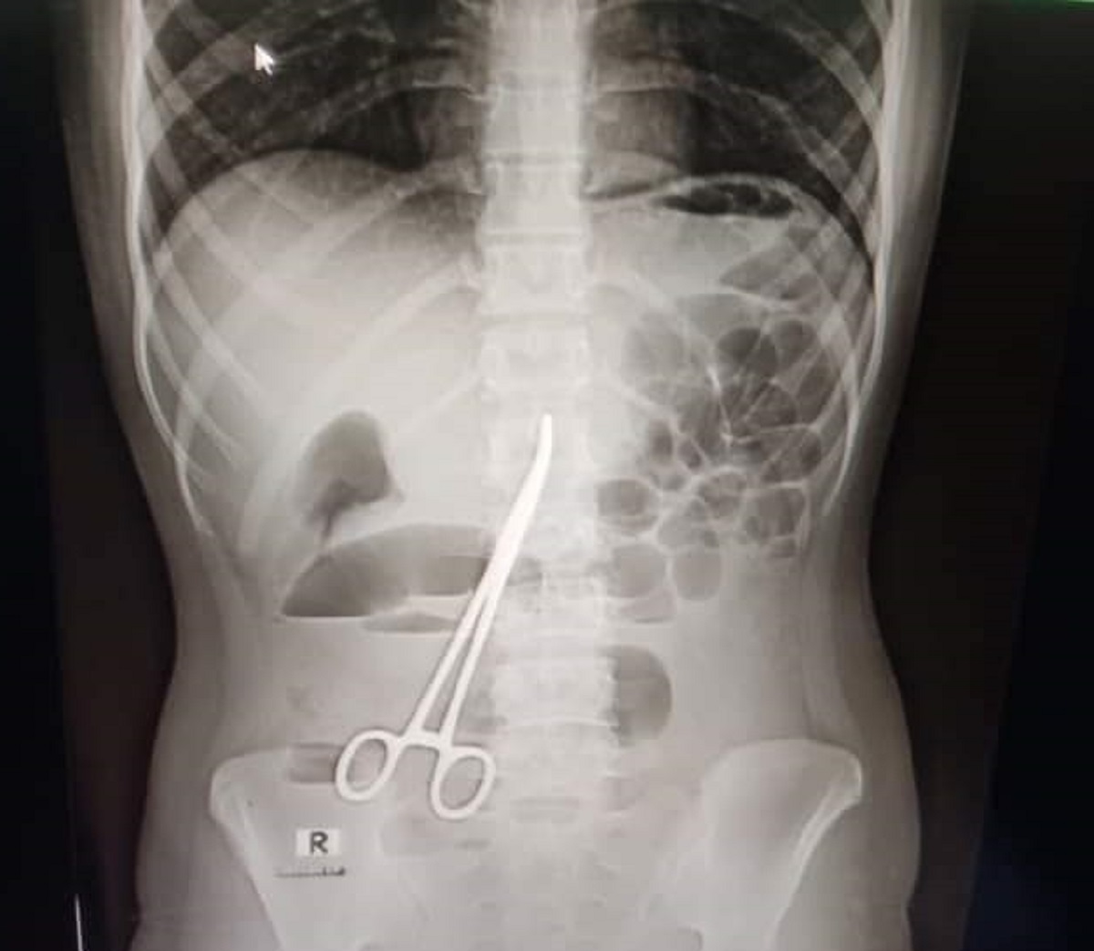 ফরিদপুরে তরুণীর পেটে কাঁচি রেখেই সেলাই, এক বছর পর জানলো পরিবার