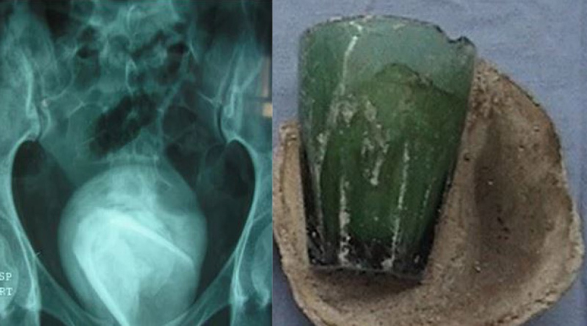 রোগীর মূত্রনালীতে মিললো কাঁচের গ্লাস! সফল অস্ত্রোপচারে বের করে আনলেন চিকিৎসকরা