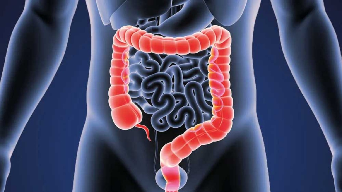 যেসব লক্ষণ চিনিয়ে দেবে কোলন ক্যানসার