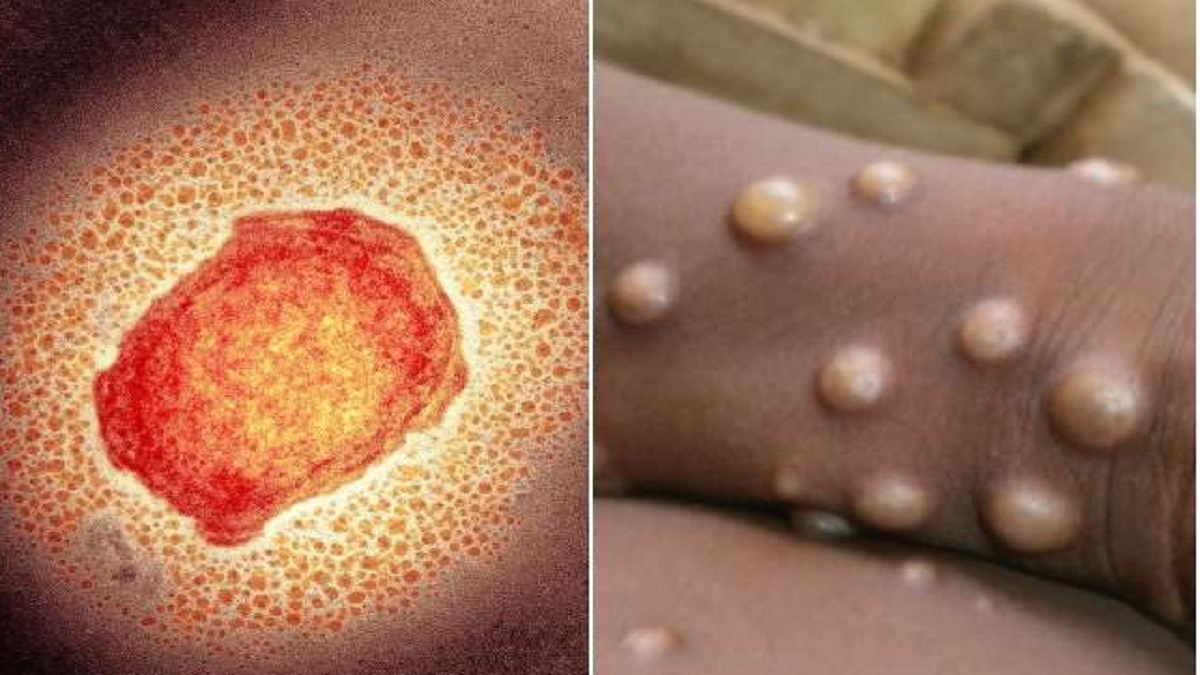 ভারতে মাঙ্কিপক্সের উপসর্গ নিয়ে হাসপাতালে ভর্তি শিশু