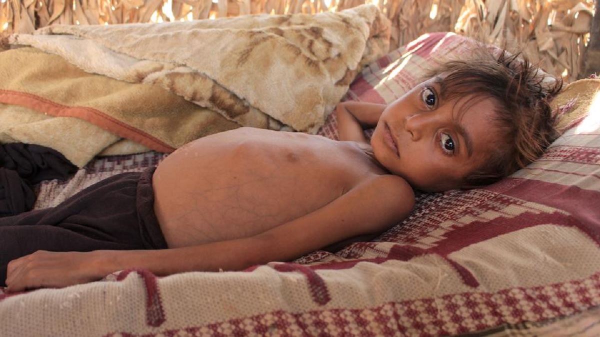 ভয়াবহ পুষ্টিহীনতায় আফগানিস্তানে বেড়েছে শিশুমৃত্যুর হার, আন্তর্জাতিক সহায়তা চালুর আহ্বান