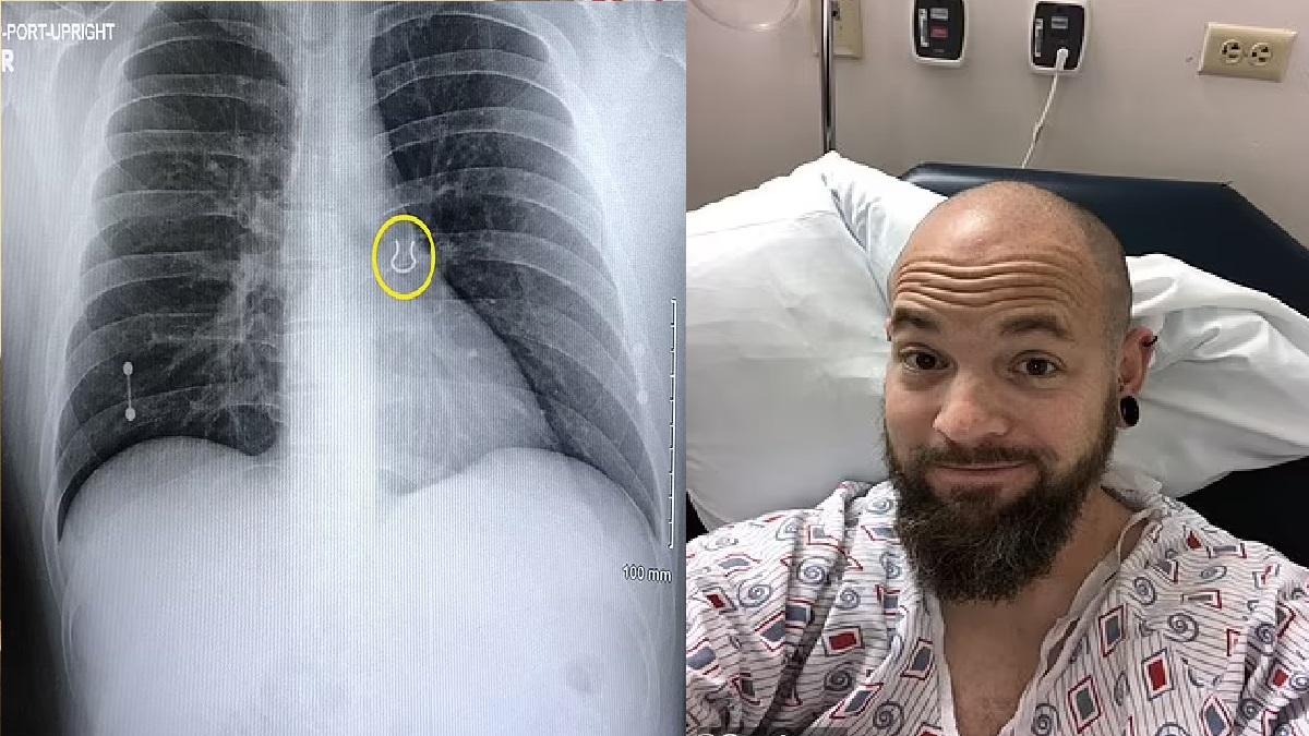 পাঁচ বছর আগে হারানো নাকের নোলক মিললো যুবকের ফুসফুসে