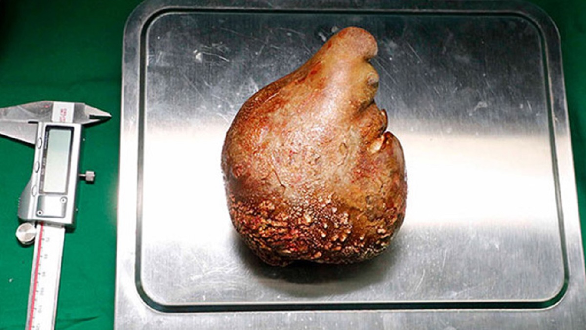 বিশ্বের বৃহত্তম কিডনি পাথর অপসারণ, নাম উঠলো গিনেস রেকর্ডে