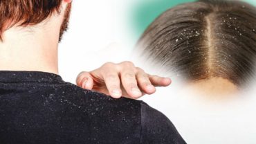 বর্ষায় খুশকির সমস্যা এড়াতে ৫ পরামর্শ
